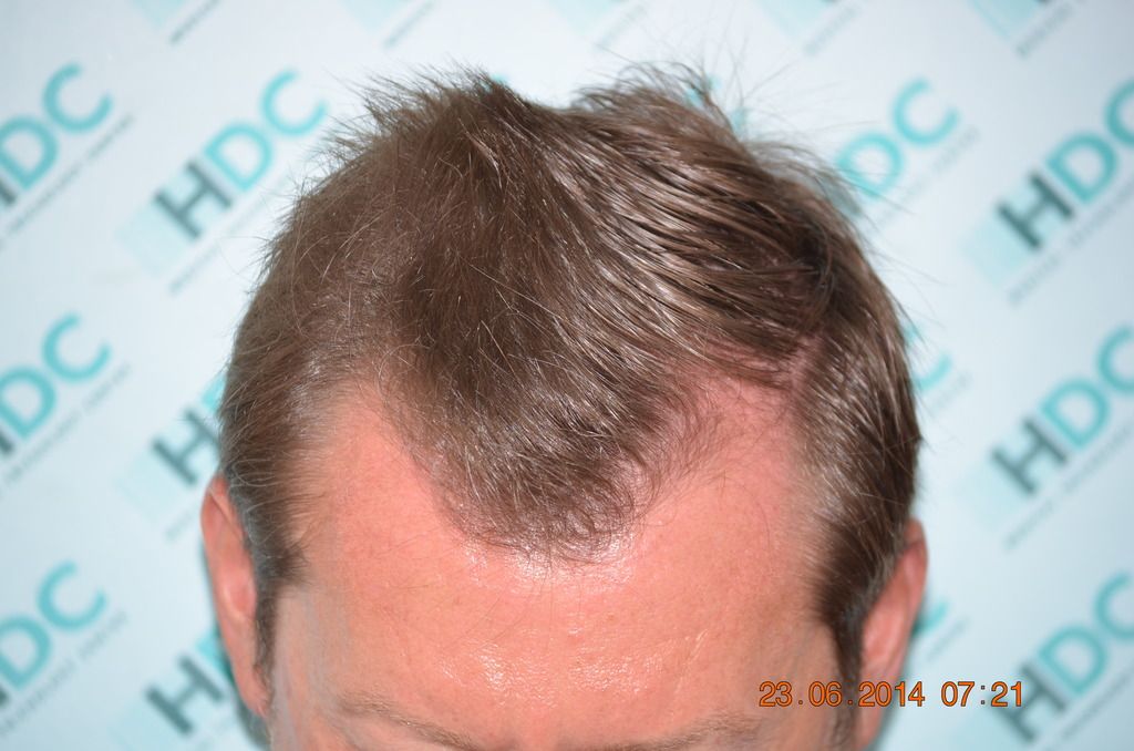 Sign of early hair loss or am I being paranoid tressless
